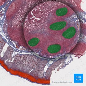 Conglomerados linfonodulares ileales (de Peyer) (Noduli lymphoidei aggregati submucosi); Imagen: 