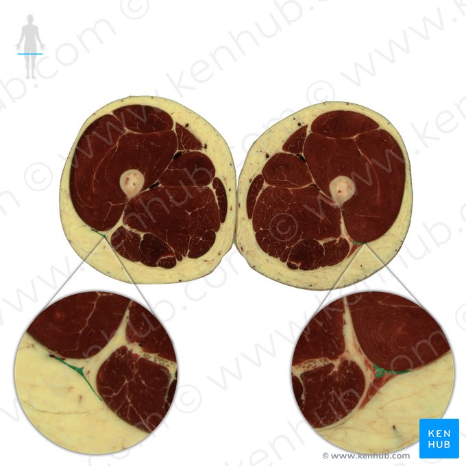 Trato iliotibial (Tractus iliotibialis); Imagem: National Library of Medicine