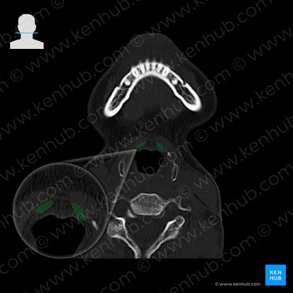 Preepiglottic fat body (Corpus adiposum preepiglotticum); Image: 