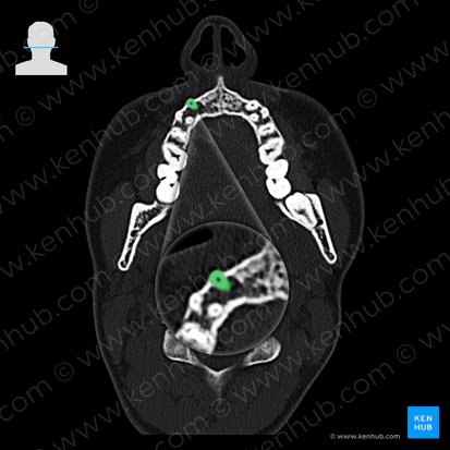 Maxillary right canine tooth (Dens caninus dexter maxillaris); Image: 