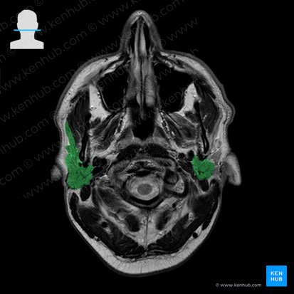 Parotid gland (Glandula parotidea); Image: 