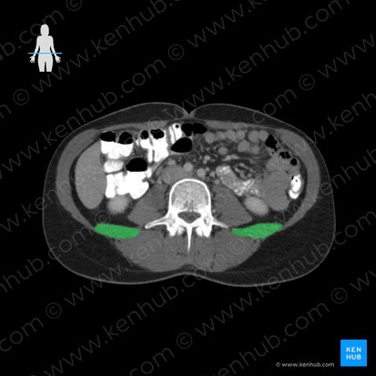 Musculus quadratus lumborum (Viereckiger Lendenmuskel); Bild: 
