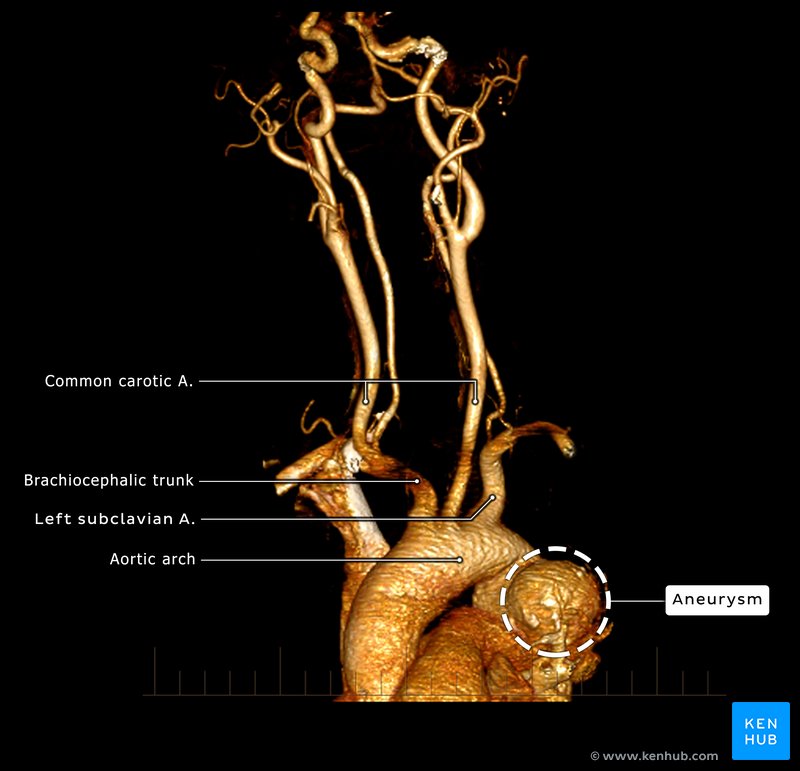 CT angiogram - aortic aneurysm