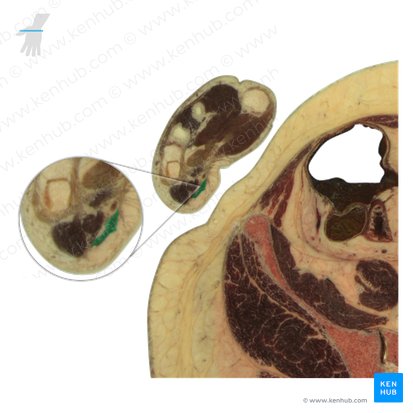 Musculus palmaris brevis (Kurzer Hohlhandmuskel); Bild: National Library of Medicine