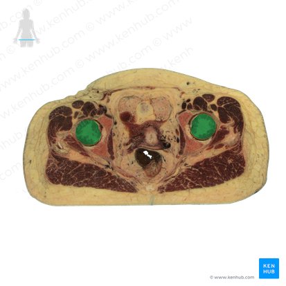 Caput femoris (Oberschenkelkopf); Bild: National Library of Medicine