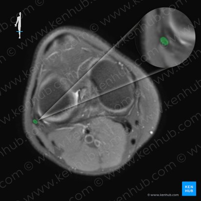 Ligamentum collaterale fibulare genus (Äußeres Kollateralband des Kniegelenks); Bild: 