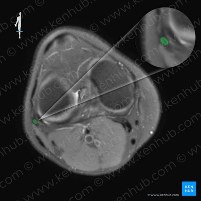 Ligamentum collaterale fibulare genus (Äußeres Kollateralband des Knies); Bild: 