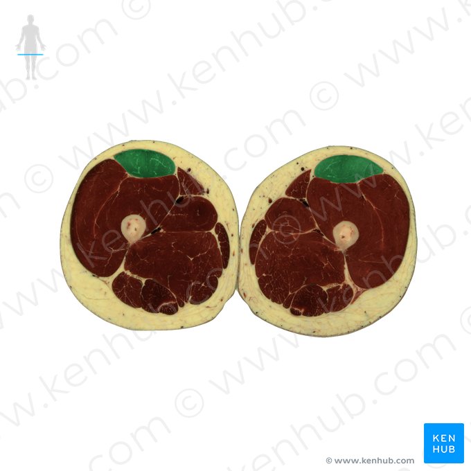 Musculus rectus femoris (Gerader Oberschenkelmuskel); Bild: National Library of Medicine