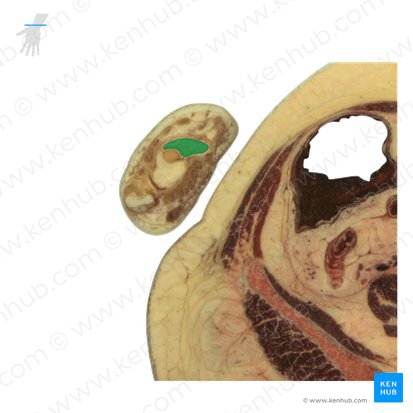 Scaphoid bone (Os scaphoideum); Image: National Library of Medicine