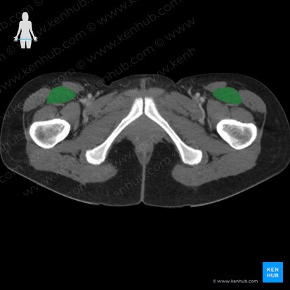 Musculus rectus femoris (Gerader Oberschenkelmuskel); Bild: 