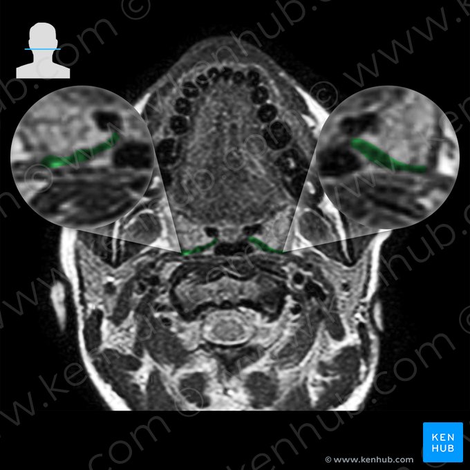 Músculo palatofaríngeo (Musculus palatopharyngeus); Imagem: 