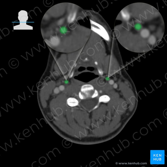 External carotid artery (Arteria carotis externa); Image: 