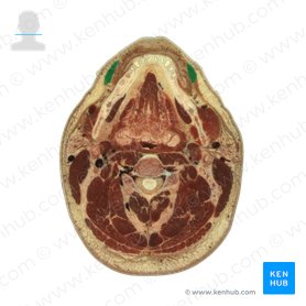 Depressor anguli oris muscle (Musculus depressor anguli oris); Image: National Library of Medicine