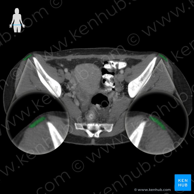 Musculus tensor fasciae latae (Schenkelbindenspanner); Bild: 