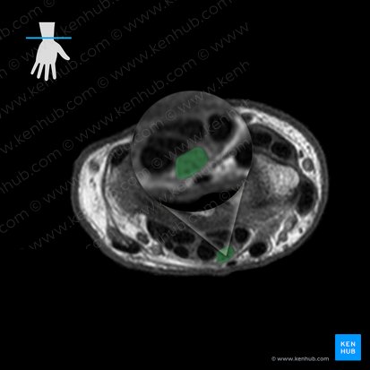 Nervo mediano (Nervus medianus); Imagem: 