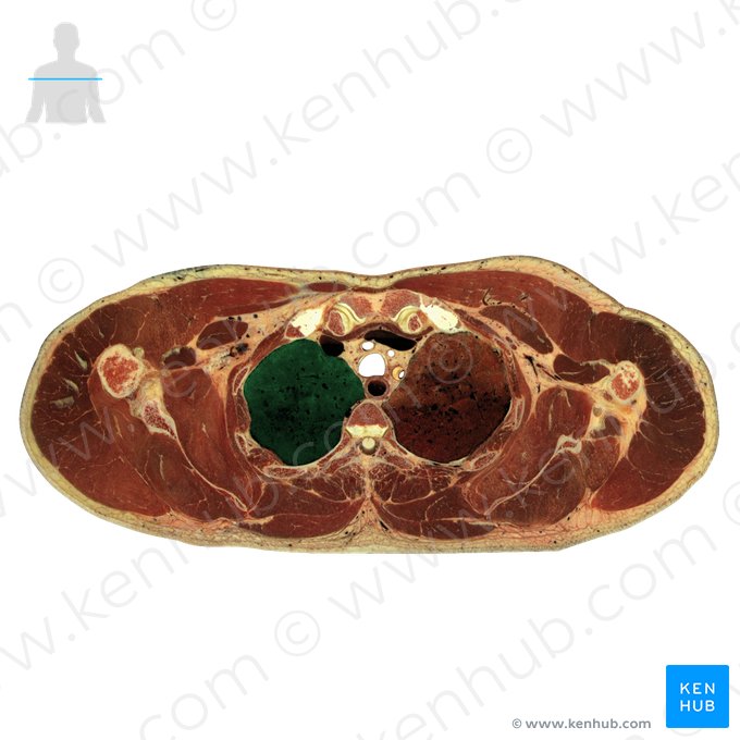 Superior lobe of right lung (Lobus superior pulmonis dextri); Image: National Library of Medicine