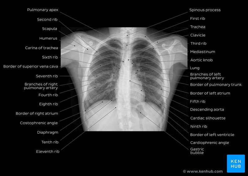 Chest X-ray: Posteroanterior (PA) view