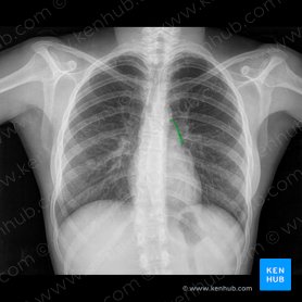 Borda do tronco pulmonar (Margo trunci pulmonalis); Imagem: 