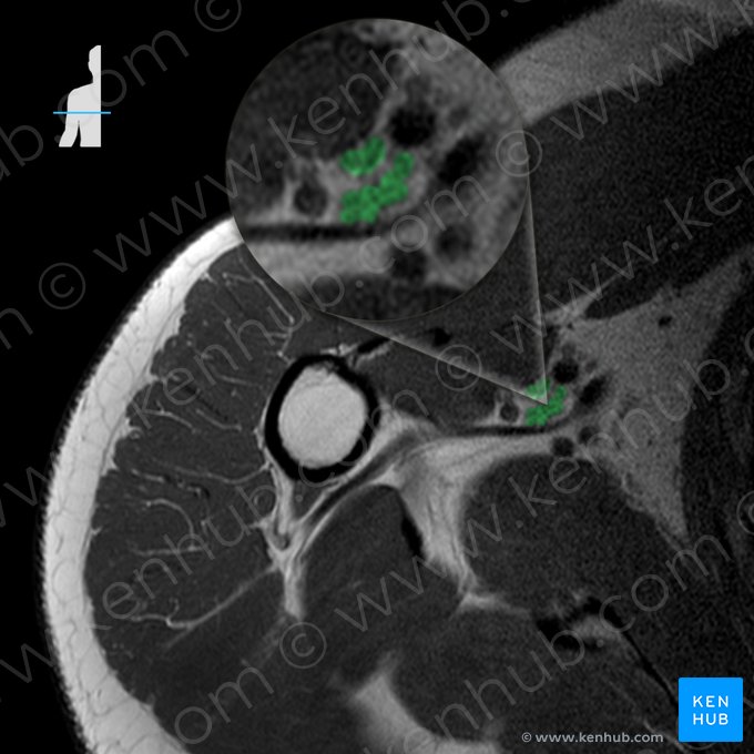 Plexus brachialis (Armgeflecht); Bild: 