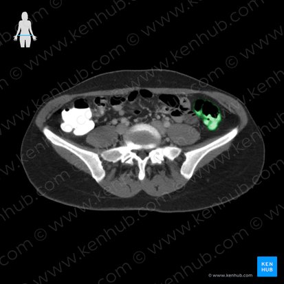 Descending colon (Colon descendens); Image: 