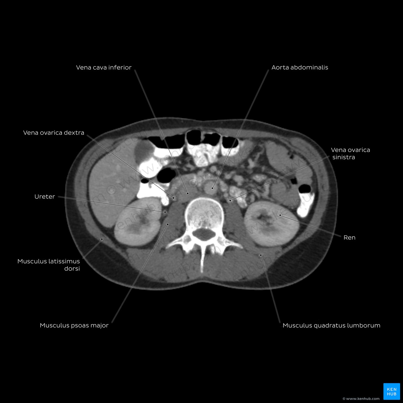 Abdomen-CT - Übersicht auf Höhe von L3