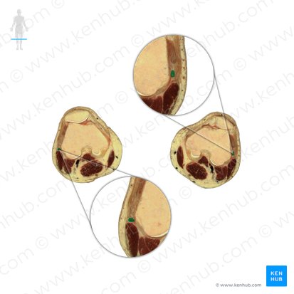 Ligamentum collaterale fibulare genus (Äußeres Kollateralband des Knies); Bild: National Library of Medicine