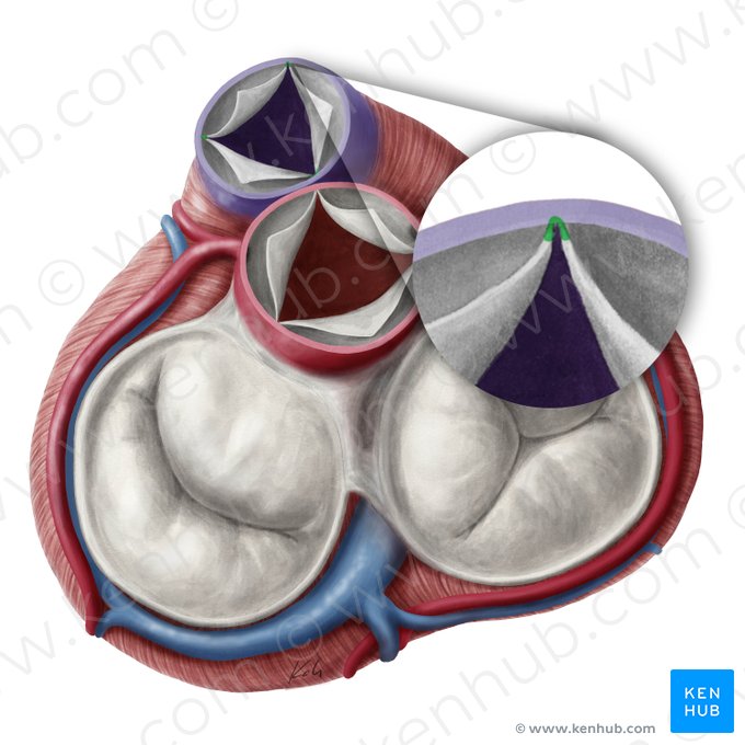 Comisuras de las válvulas semilunares de la valva pulmonar (Commissurae valvularum semilunarium valvae trunci pulmonalis); Imagen: Yousun Koh