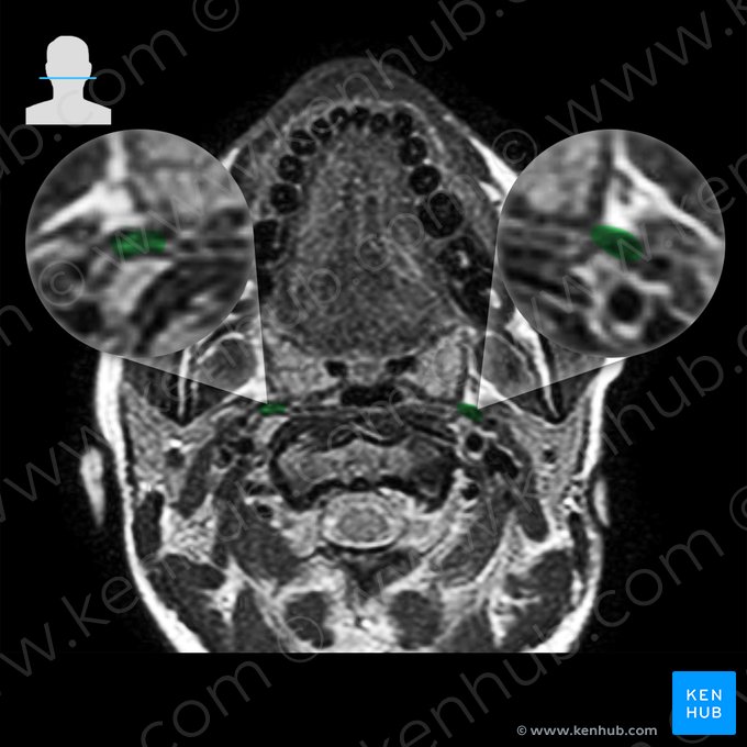 Músculo estilofaríngeo (Musculus stylopharyngeus); Imagem: 