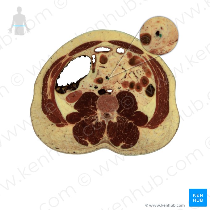 Arteria mesenterica superior (Obere Eingeweidearterie); Bild: National Library of Medicine