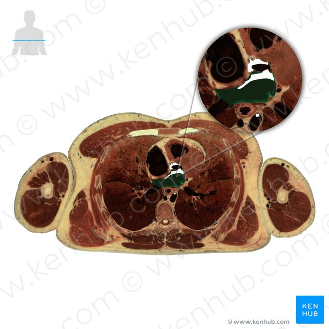 Left atrium of heart (Atrium sinistrum cordis); Image: National Library of Medicine