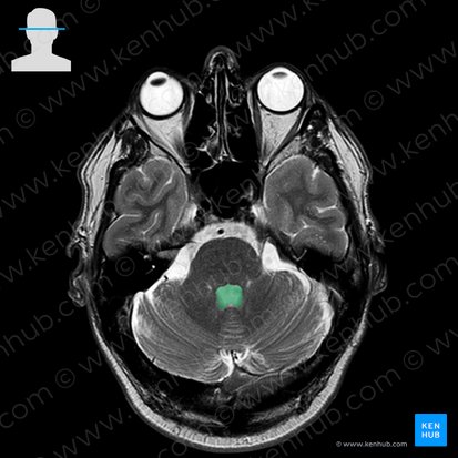Ventriculus quartus (Vierter Ventrikel); Bild: 