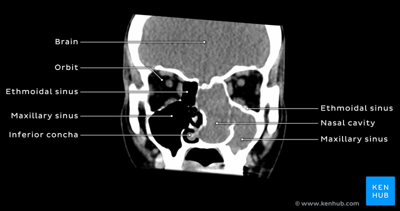 Opacified left nasal cavity and maxillary sinus - coronal CT