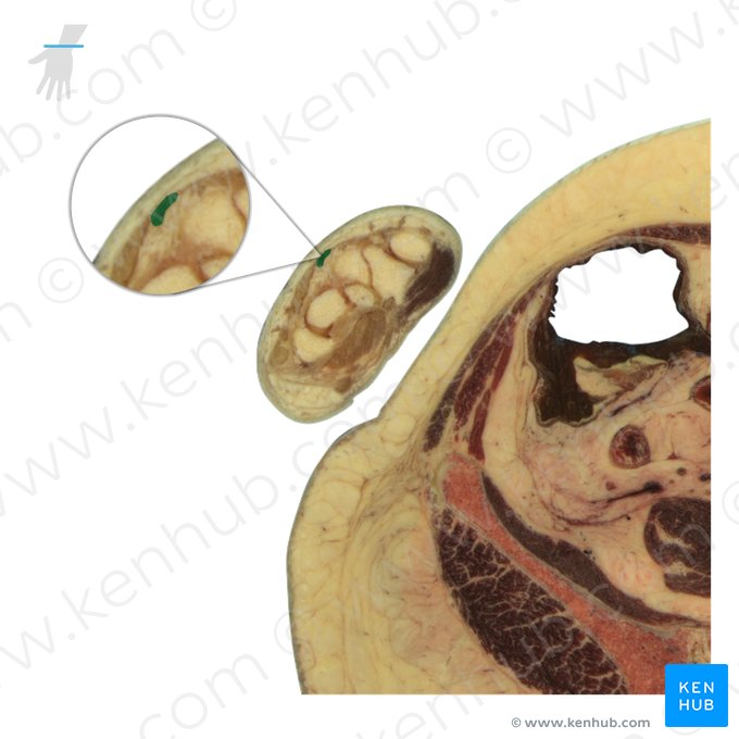 Tendão do músculo extensor radial curto do carpo (Tendo musculi extensor carpi radialis brevis); Imagem: National Library of Medicine