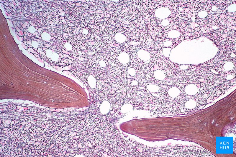 Reticulin Stain (Marrow in Myeloproliferative Disorder)