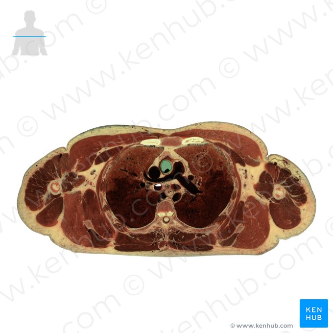 Aorta ascendens; Bild: National Library of Medicine