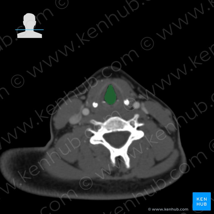 Infraglottic cavity (Cavitas infraglottica); Image: 