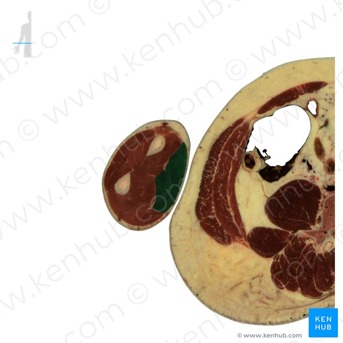 Músculo flexor superficial dos dedos (Musculus flexor digitorum superficialis); Imagem: National Library of Medicine