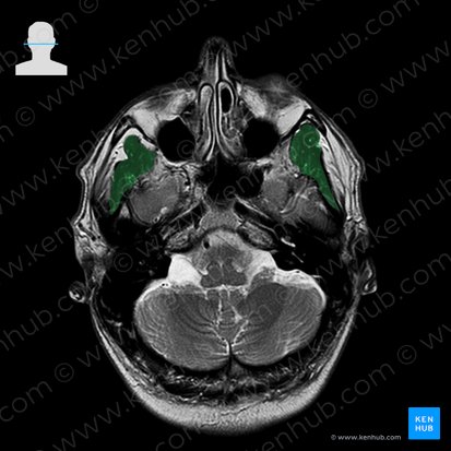 Musculus temporalis (Schläfenmuskel); Bild: 