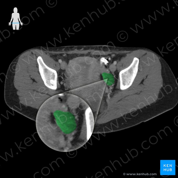 Ovario izquierdo (Ovarium sinistrum); Imagen: 