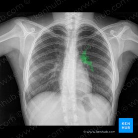 Ramos da artéria pulmonar esquerda (Rami arteriae pulmonalis sinistrae); Imagem: 