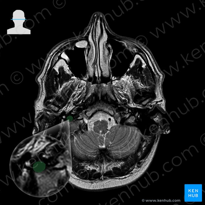 Vena yugular interna derecha (Vena jugularis interna dextra); Imagen: 