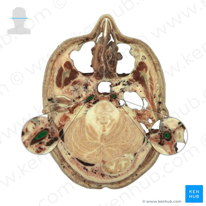 Artéria carótida interna (Arteria carotis interna); Imagem: National Library of Medicine