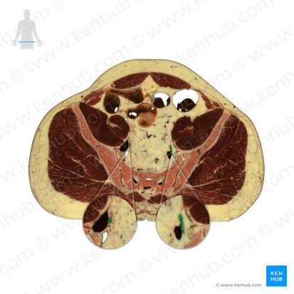 Arteria ilíaca interna (Arteria iliaca interna); Imagen: National Library of Medicine
