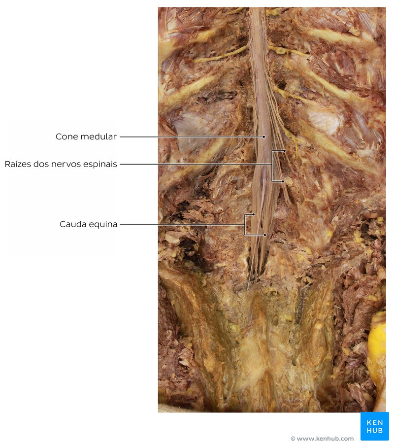 Cauda equina em um cadáver