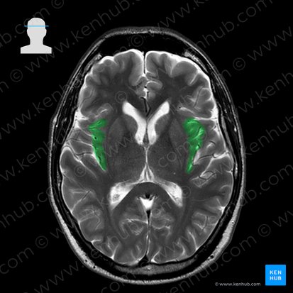 Insular lobe (Insula); Image: 