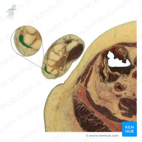 Tendon of extensor carpi ulnaris muscle (Tendo musculi extensoris carpi ulnaris); Image: National Library of Medicine