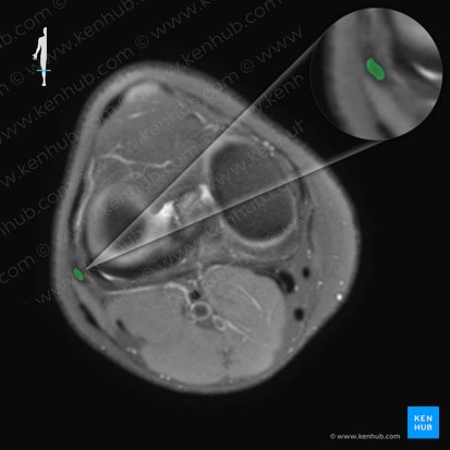 Ligamento colateral fibular de la articulación de la rodilla (Ligamentum collaterale fibulare genus); Imagen: 