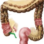 Appendix vermiformis (Wurmfortsatz)