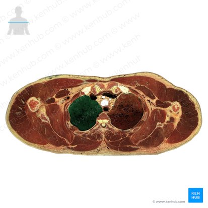 Lobus superior pulmonis dextri (Oberlappen der rechten Lunge); Bild: National Library of Medicine