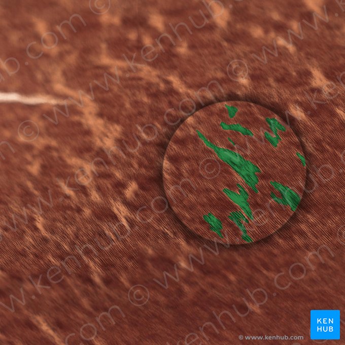 Dentina Interglobular; Imagen: 